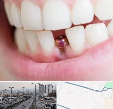 ایمپلنت اقساطی در بلوار ارتش