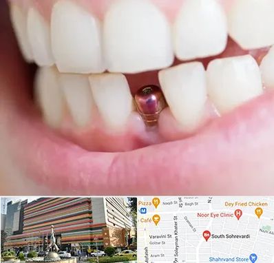 ایمپلنت اقساطی در سهروردی 