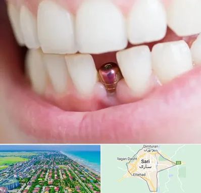 ایمپلنت اقساطی در ساری