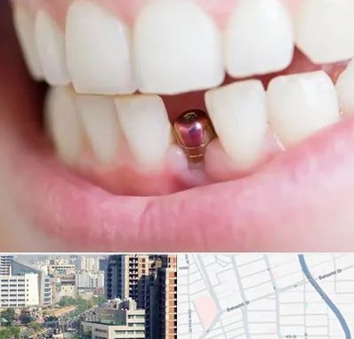 ایمپلنت اقساطی در خیابان بهشتی