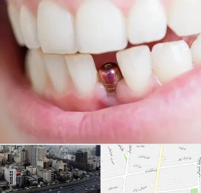 ایمپلنت اقساطی در زرتشت