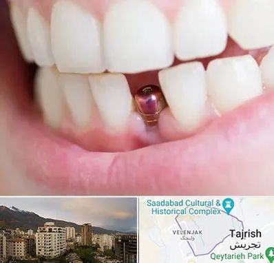 ایمپلنت اقساطی در زعفرانیه 