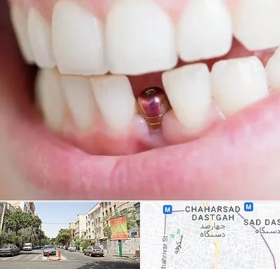 ایمپلنت اقساطی در چهارصد دستگاه 