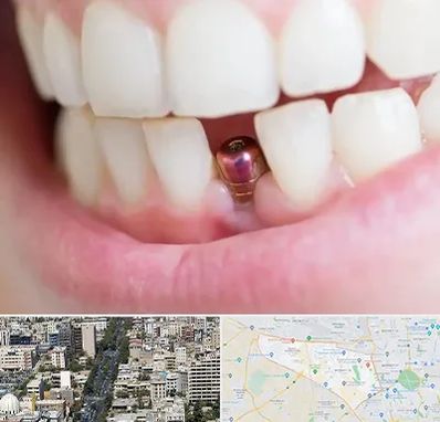 ایمپلنت اقساطی در منطقه 18 تهران 