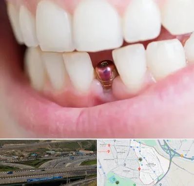 ایمپلنت اقساطی در یاغچیان تبریز