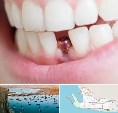 ایمپلنت اقساطی در چابهار