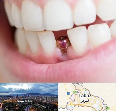 ایمپلنت اقساطی در تبریز