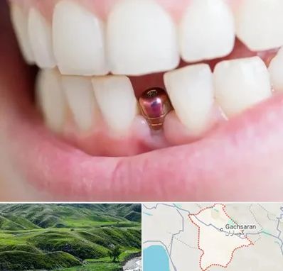 ایمپلنت اقساطی در گچساران