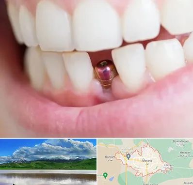 ایمپلنت اقساطی در مرند