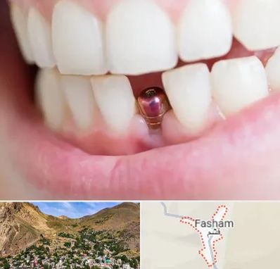 ایمپلنت اقساطی در فشم