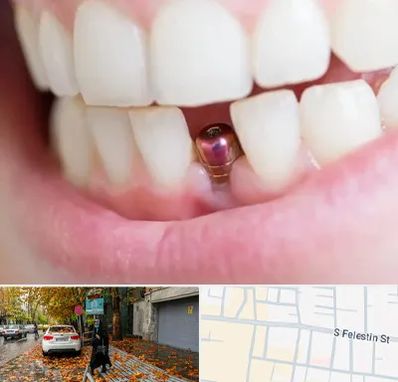ایمپلنت اقساطی در خیابان فلسطین
