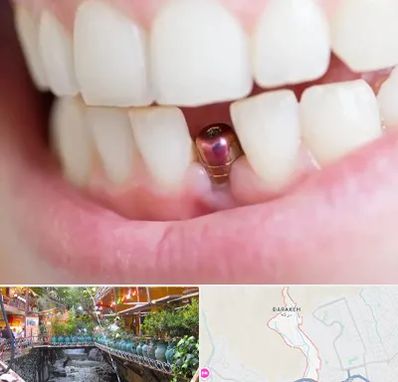 ایمپلنت اقساطی در درکه