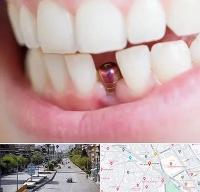 ایمپلنت اقساطی در خیابان زند شیراز