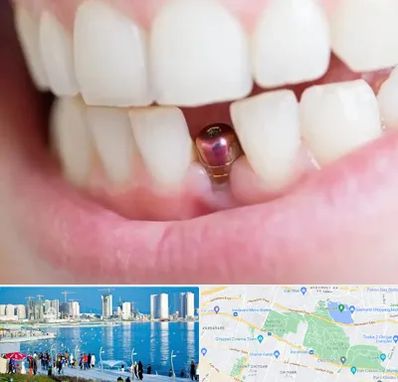 ایمپلنت اقساطی در چیتگر 