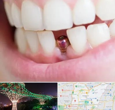 ایمپلنت اقساطی در منطقه 3 تهران 