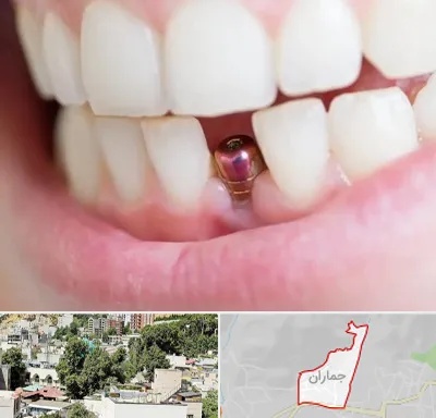 ایمپلنت اقساطی در جماران