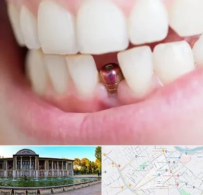 ایمپلنت اقساطی در عفیف آباد شیراز