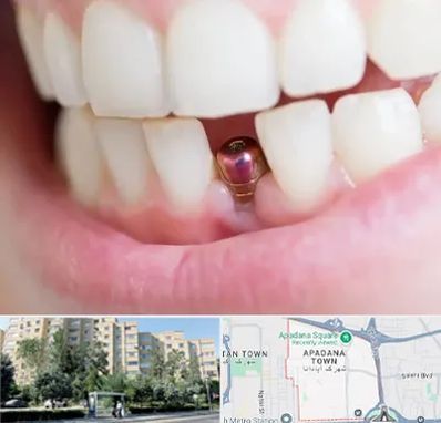 ایمپلنت اقساطی در آپادانا