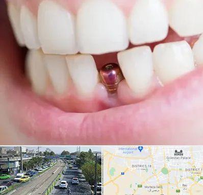 ایمپلنت اقساطی در جنوب تهران 