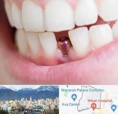 ایمپلنت اقساطی در آجودانیه 