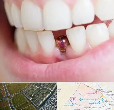 ایمپلنت اقساطی در الهیه مشهد