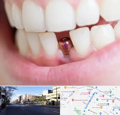 ایمپلنت اقساطی در خیابان ملاصدرا شیراز