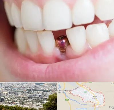 ایمپلنت اقساطی در یاسوج