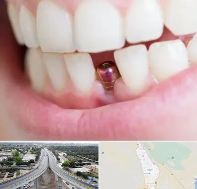 ایمپلنت اقساطی در اندیمشک