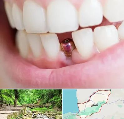 ایمپلنت اقساطی در گلستان