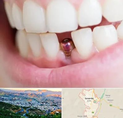 ایمپلنت اقساطی در سنندج