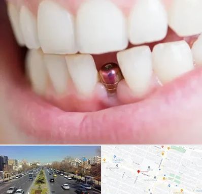 ایمپلنت اقساطی در بلوار معلم مشهد 