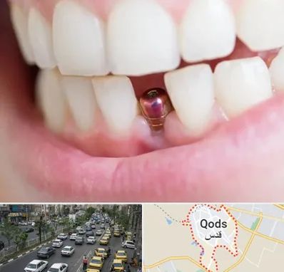 ایمپلنت اقساطی در شهر قدس