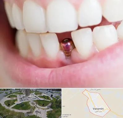 ایمپلنت اقساطی در ورامین