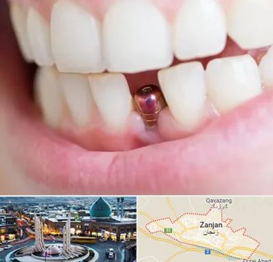 ایمپلنت اقساطی در زنجان