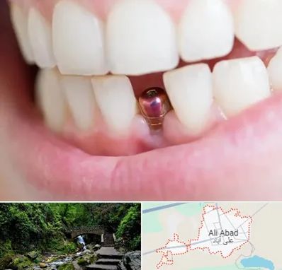 ایمپلنت اقساطی در علی آباد کتول
