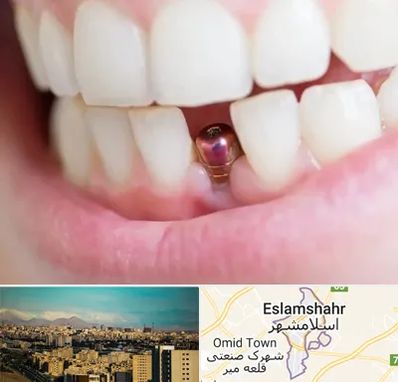 ایمپلنت اقساطی در اسلامشهر