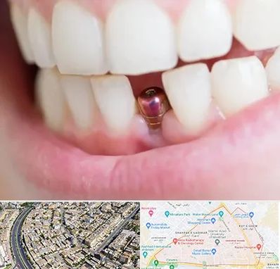 ایمپلنت اقساطی در شهرک غرب مشهد