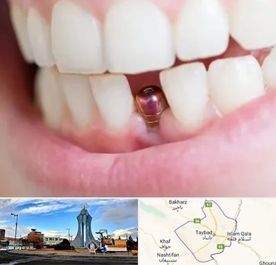 ایمپلنت اقساطی در تایباد