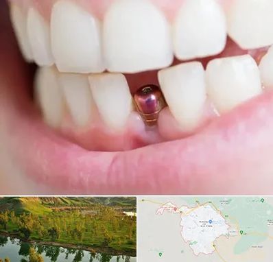 ایمپلنت اقساطی در بهبهان