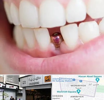 ایمپلنت اقساطی در منیریه 