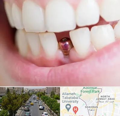 ایمپلنت اقساطی در شهران 