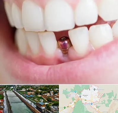 ایمپلنت اقساطی در مراغه