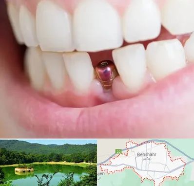 ایمپلنت اقساطی در بهشهر
