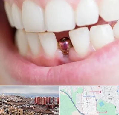 ایمپلنت اقساطی در سهند تبریز