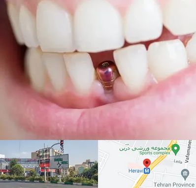 ایمپلنت اقساطی در هروی 