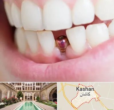 ایمپلنت اقساطی در کاشان