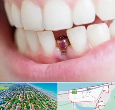 ایمپلنت اقساطی در نور