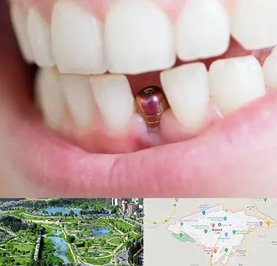 ایمپلنت اقساطی در بجنورد