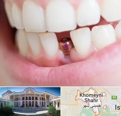 ایمپلنت اقساطی در خمینی شهر