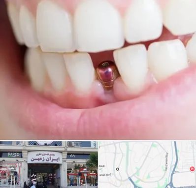 ایمپلنت اقساطی در ایران زمین